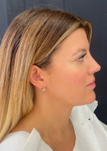 Fat transfer to Face Before & After Patient #11801