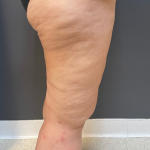 Thigh Lift Before & After Patient #11838