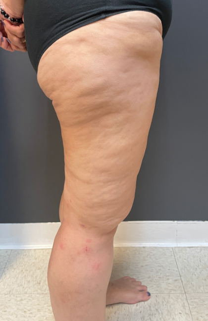 Thigh Lift Before & After Patient #11838
