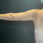 Arm Lift Before & After Patient #11837