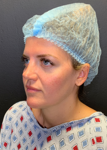 Fat transfer to Face Before & After Patient #11801