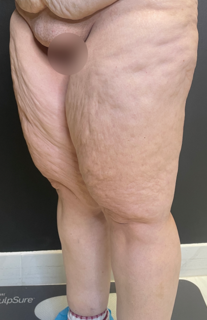Thigh Lift Before & After Patient #11838