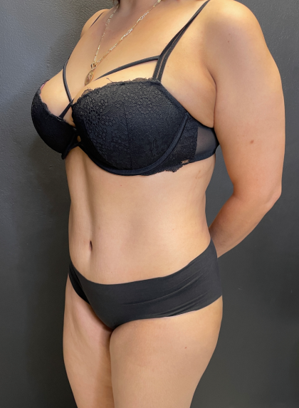 Tummy Tuck Before & After Patient #11788