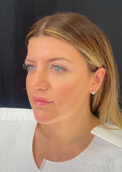 Fat transfer to Face Before & After Patient #11801