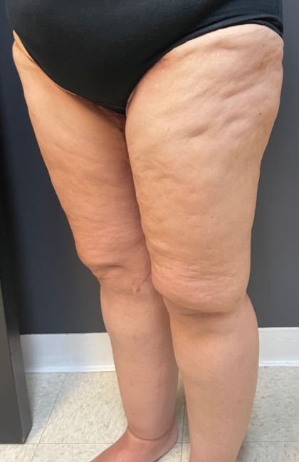 Thigh Lift Before & After Patient #11838