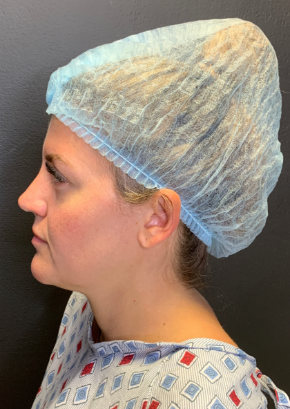 Fat transfer to Face Before & After Patient #11801