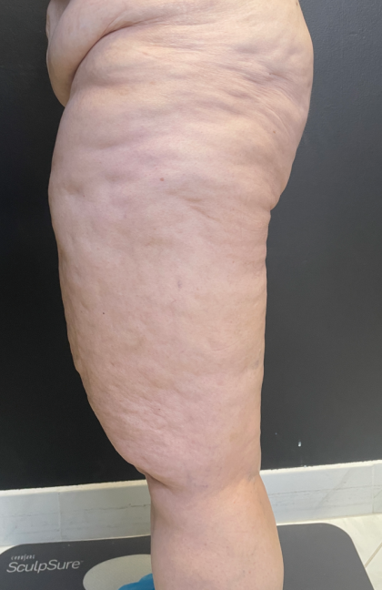 Thigh Lift Before & After Patient #11838