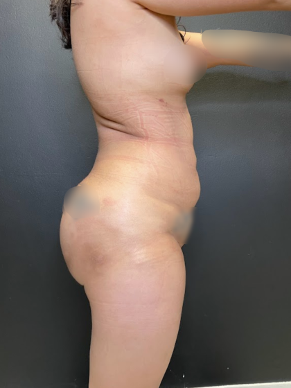 Brazilian Butt Lift Before & After Patient #11743