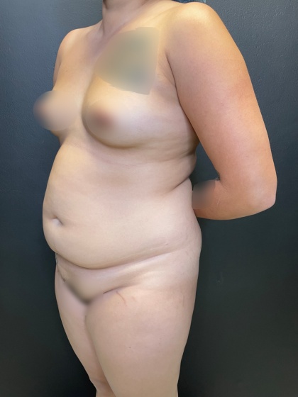 Brazilian Butt Lift Before & After Patient #11743