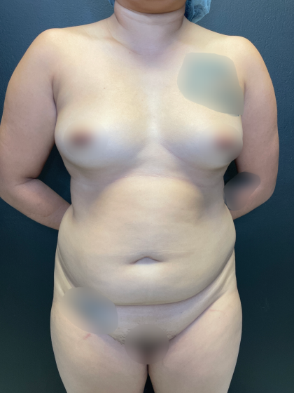 Brazilian Butt Lift Before & After Patient #11743