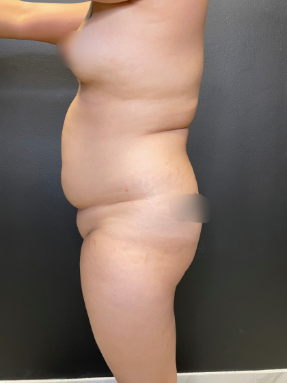 Brazilian Butt Lift Before & After Patient #11743