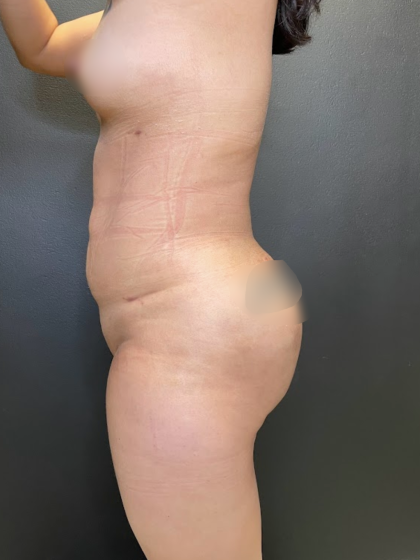 Brazilian Butt Lift Before & After Patient #11743