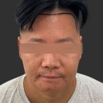 Hair Transplantation Before & After Patient #12072