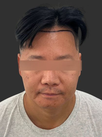 Hair Transplantation Before & After Patient #12072
