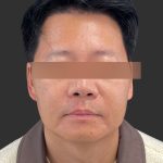 Hair Transplantation Before & After Patient #12072