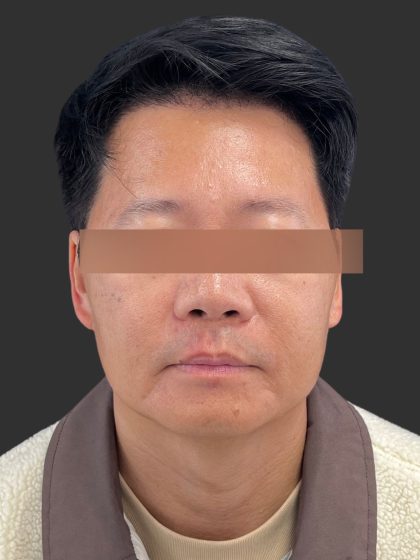 Hair Transplantation Before & After Patient #12072