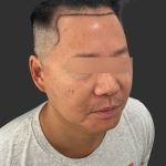 Hair Transplantation Before & After Patient #12072