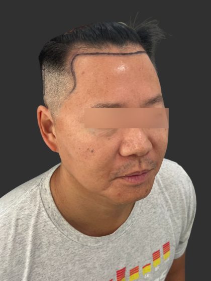 Hair Transplantation Before & After Patient #12072