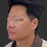 Hair Transplantation Before & After Patient #12072