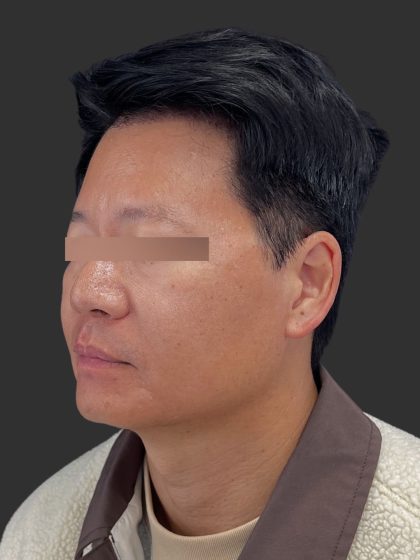 Hair Transplantation Before & After Patient #12072