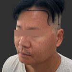 Hair Transplantation Before & After Patient #12072