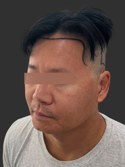 Hair Transplantation Before & After Patient #12072