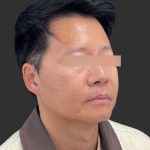 Hair Transplantation Before & After Patient #12072