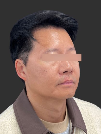 Hair Transplantation Before & After Patient #12072