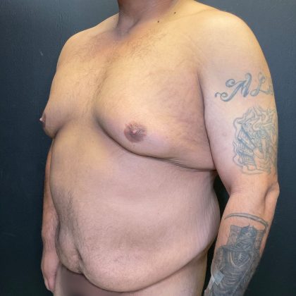 Tummy Tuck Before & After Patient #12055