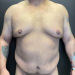 Tummy Tuck Before & After Patient #12055