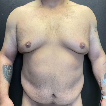 Tummy Tuck Before & After Patient #12055