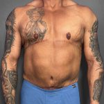 Tummy Tuck Before & After Patient #12055