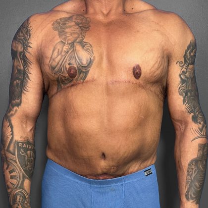 Tummy Tuck Before & After Patient #12055