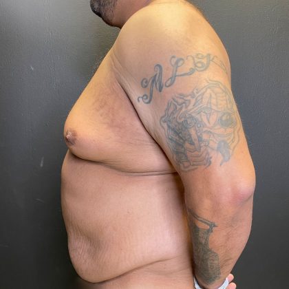 Tummy Tuck Before & After Patient #12055