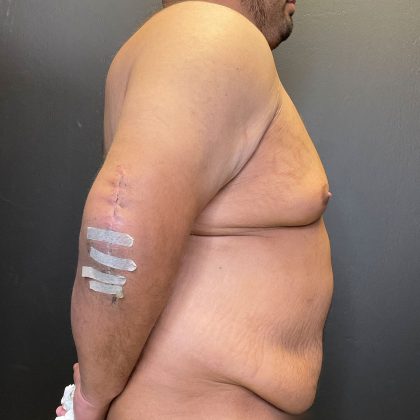 Tummy Tuck Before & After Patient #12055