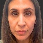 Rhinoplasty Before & After Patient #11997