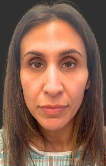 Rhinoplasty Before & After Patient #11997