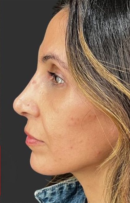 Rhinoplasty Before & After Patient #11997