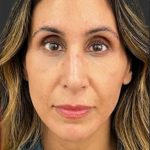 Rhinoplasty Before & After Patient #11997