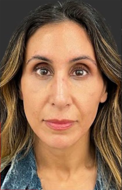 Rhinoplasty Before & After Patient #11997