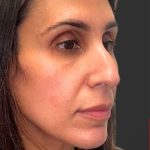 Rhinoplasty Before & After Patient #11997