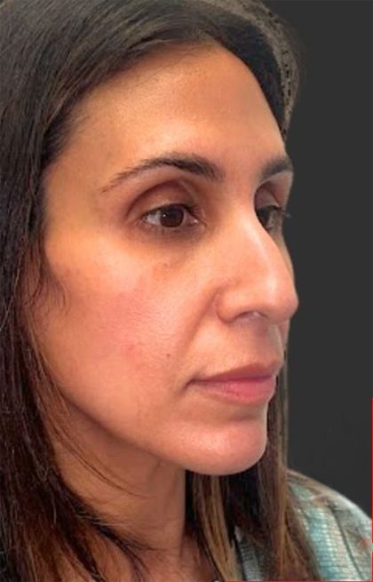 Rhinoplasty Before & After Patient #11997