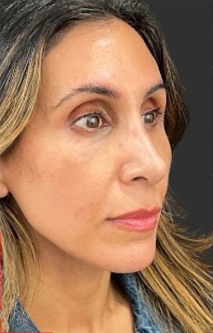 Rhinoplasty Before & After Patient #11997