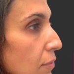 Rhinoplasty Before & After Patient #11997