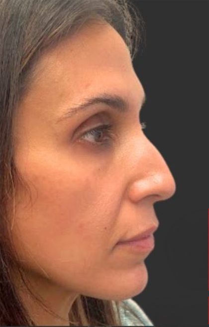 Rhinoplasty Before & After Patient #11997