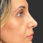 Rhinoplasty Before & After Patient #11997