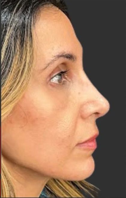 Rhinoplasty Before & After Patient #11997