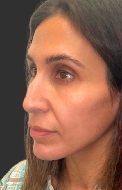 Rhinoplasty Before & After Patient #11997