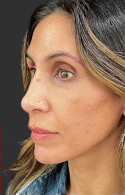 Rhinoplasty Before & After Patient #11997