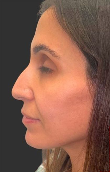 Rhinoplasty Before & After Patient #11997